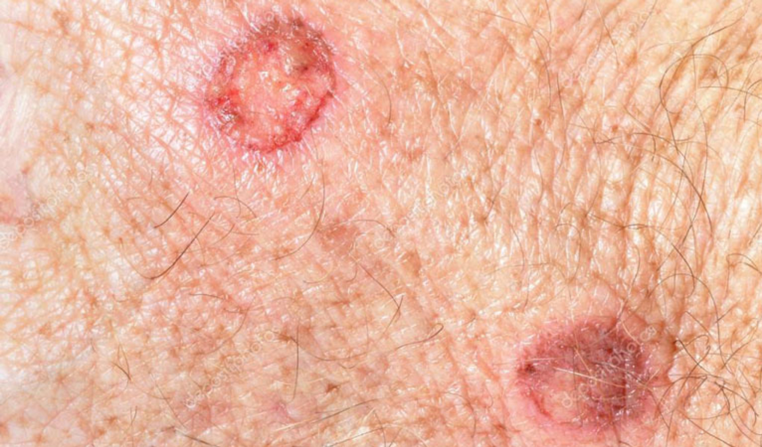 Dày sừng tiết bã - Hình ảnh minh họa